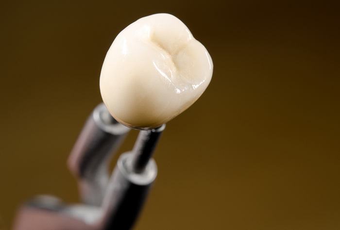 As próteses podem imitar perfeitamente um dente natural: a cor, a textura e ranhuras são praticamente iguais