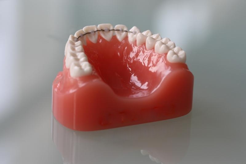 Contenção para os dentes não entortarem ortodontista florianópolis